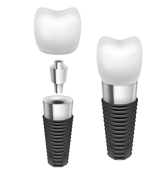 dental implants North York