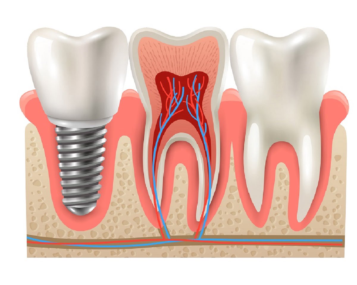 root canal treatment