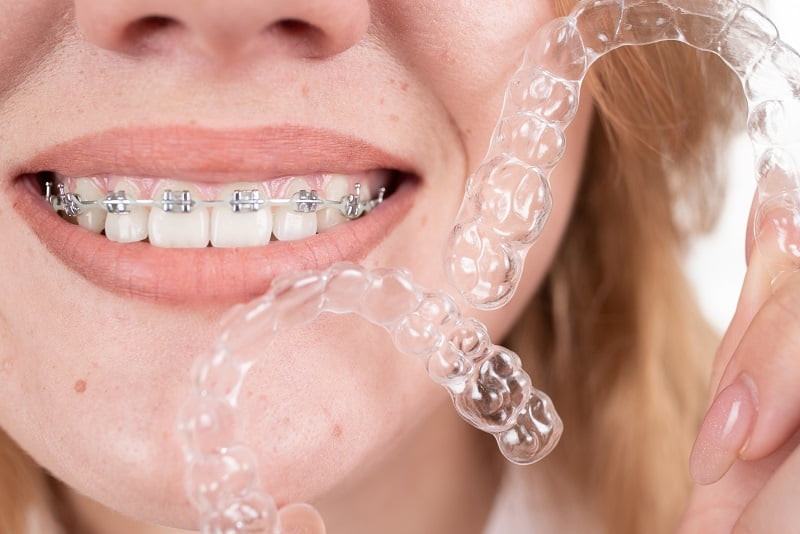 Orthodontic treatment is one of the most common and effective ways to correct crooked teeth.
