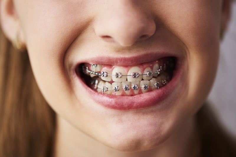 Common Issues While Having Braces and How to Fix Them