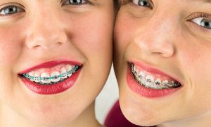 8 Things You Should Consider Before Getting Braces