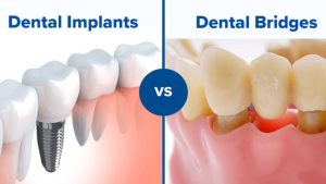 Dental Implant Vs. Bridge: The Best Choice for Tooth Replacement