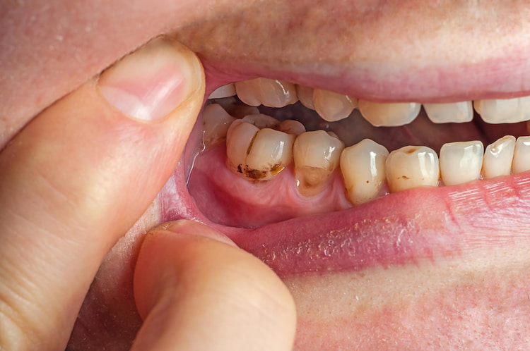 a person is showing the Amoxicillin stains on their teeth.
