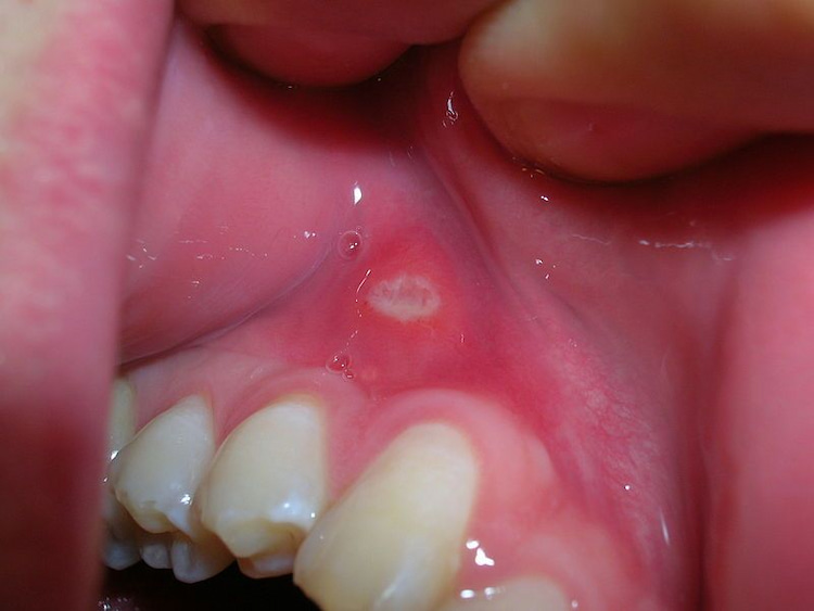 Close-up view of the inside of a person’s mouth showing redness and irritation on the gum tissue near the teeth.