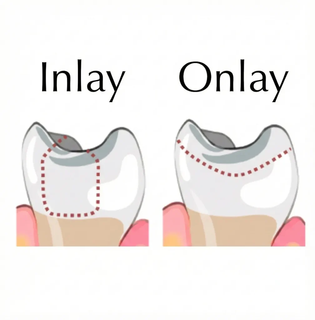 What Are Dental Inlays and Onlays