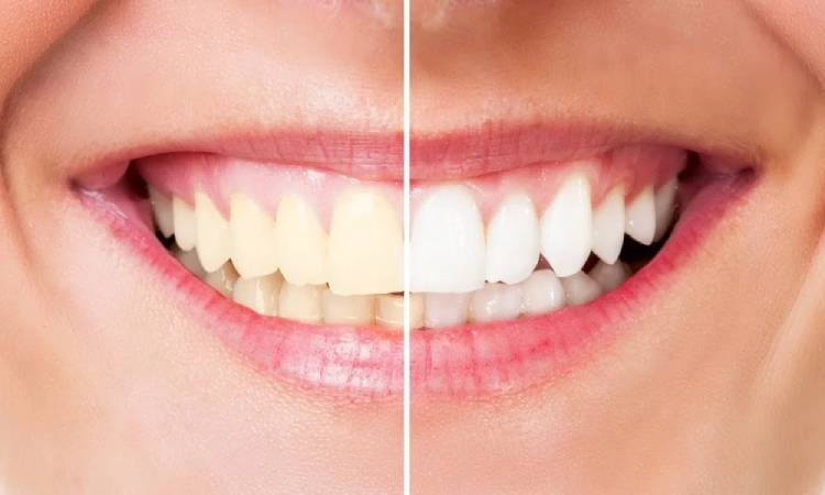 Not recommended foods after teeth whitening 