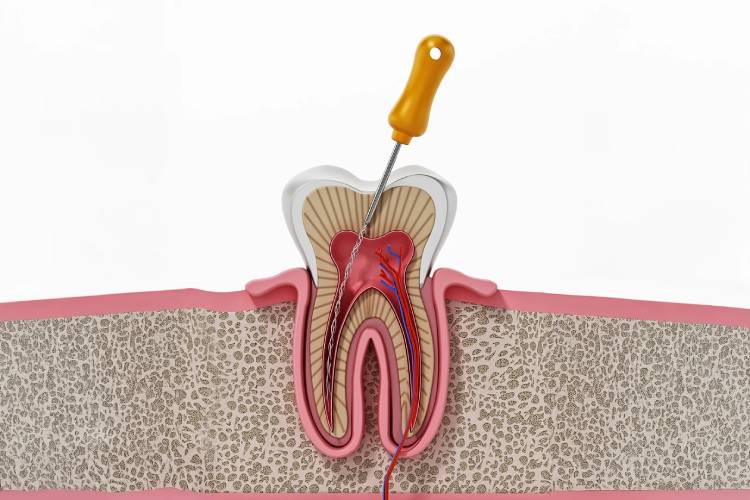Things to know about root canal pain relief 