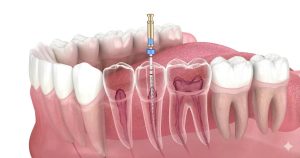 Everything about root canal pain relief