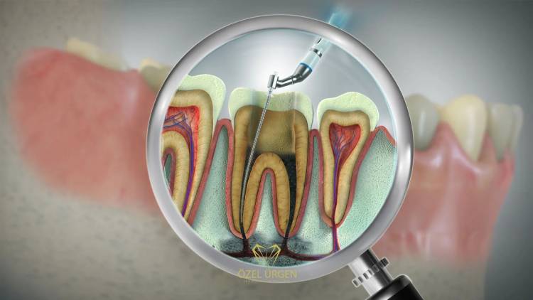 Root canal pain relief  tips to know