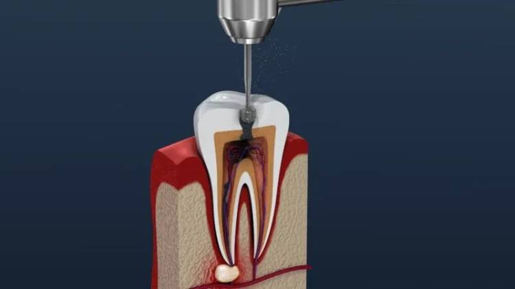 Root canal side effects: what you should know