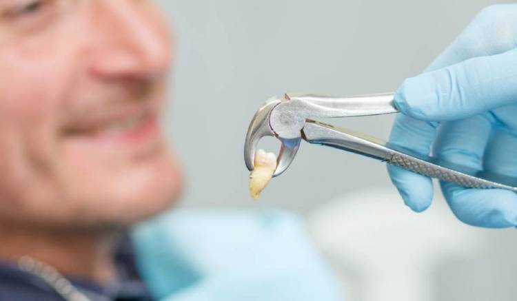 Tooth extraction healing time; things to know