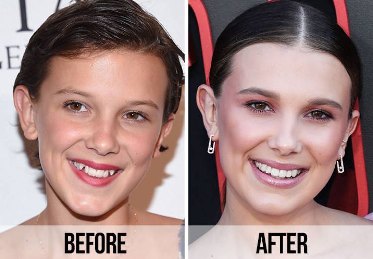 Celebrity veneers; smile change