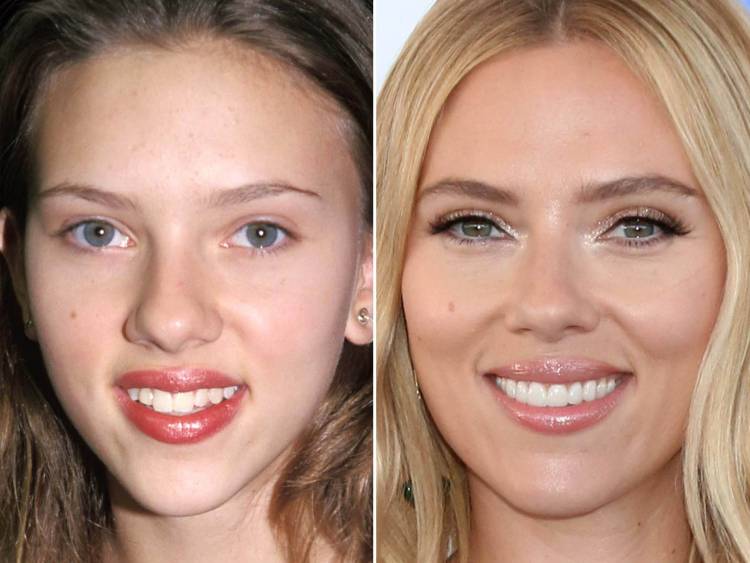 Celebrity veneers; full guide