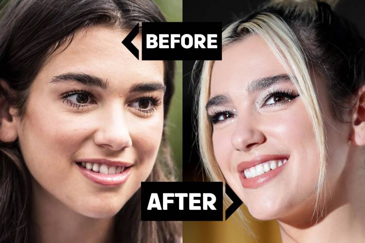 Celebrity veneers: Dua Lipa