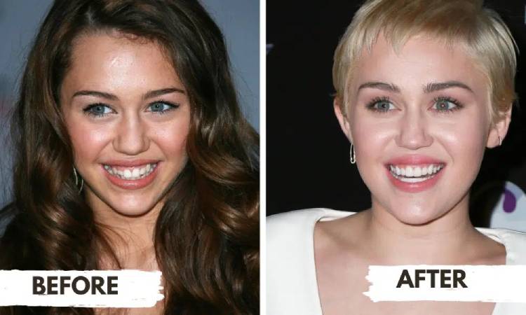 Celebrity veneers; Miley Cyrus