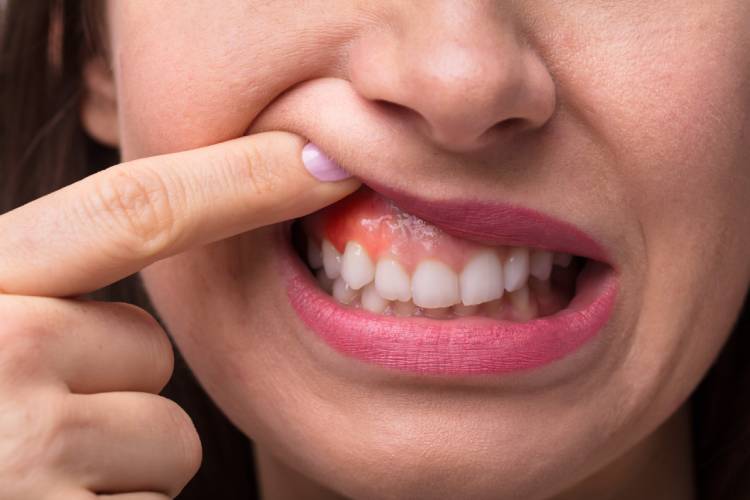 All about gum abscess