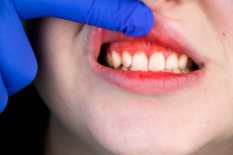 What to do with a Gum Abscess