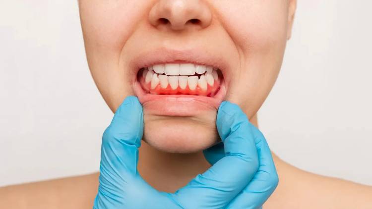 Causes of bleeding gums