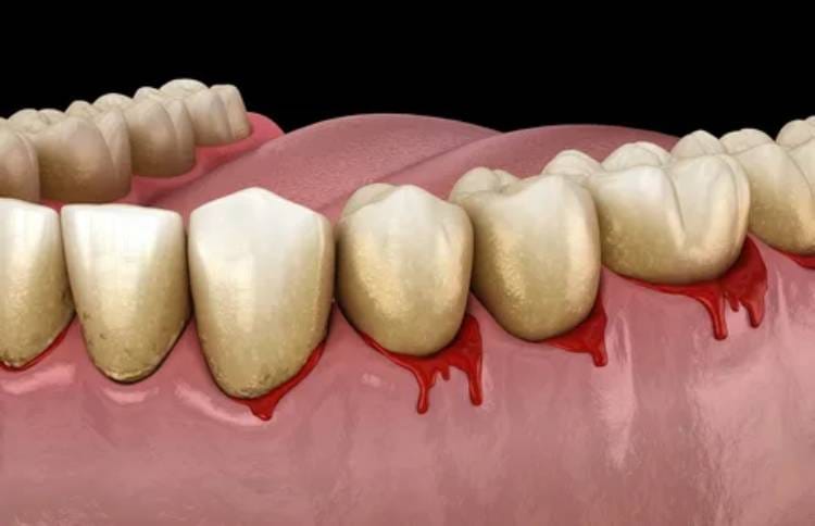 Real causes of bleeding gums