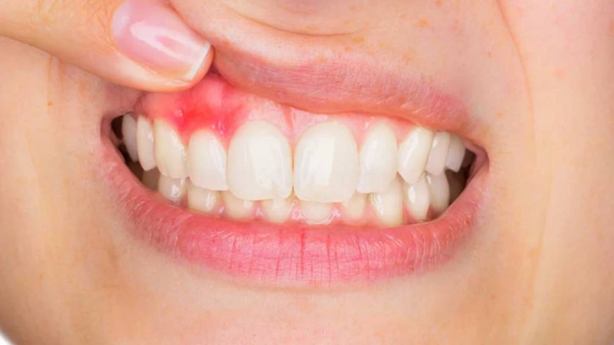 How to treat gum abscess