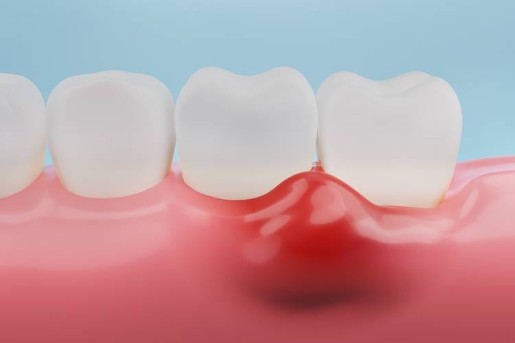 Gum Abscess; tips to know about