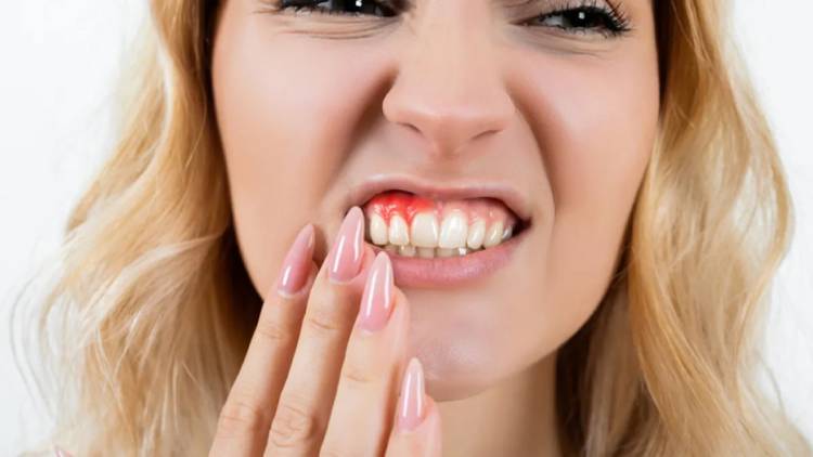 Main causes of bleeding gums