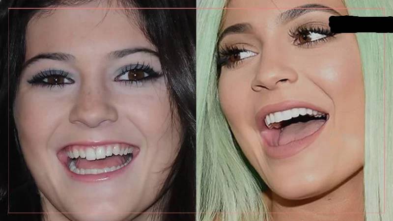Celebrity veneers: Kylie Jenner