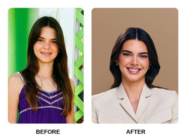 Celebrity veneers: Kendall Jenner