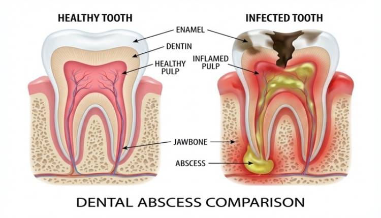 Signs that a tooth infection is spreading