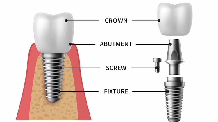 Screwless dental implants
