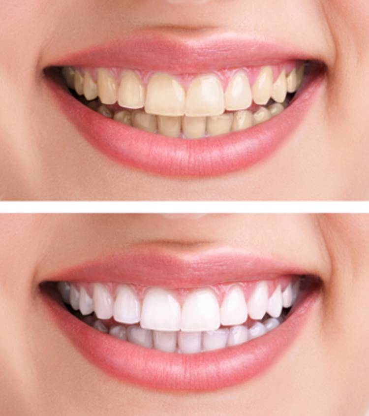 whitening fillings on front teeth
