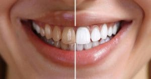 whitening fillings on front teeth