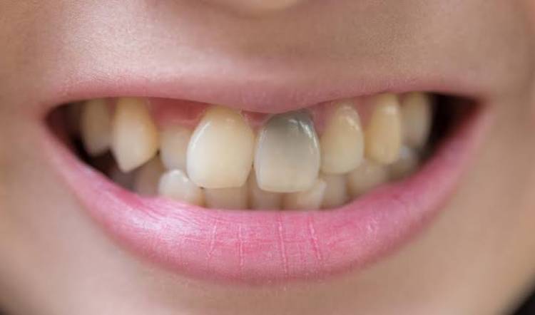 whitening fillings on front teeth