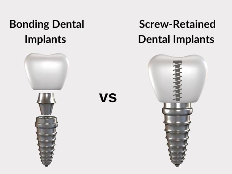 Screwless dental implants