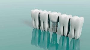 screwless dental implants in Toronto