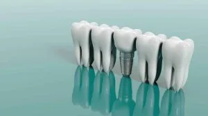 screwless dental implants in Toronto