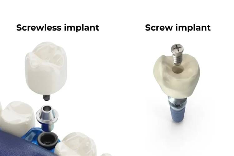 Screwless dental implants
