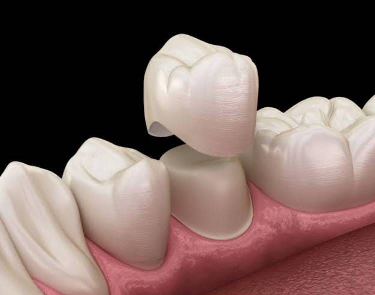 Dental crown cost in Toronto