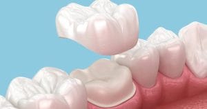 Dental crown cost in Toronto