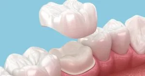 Dental crown cost in Toronto