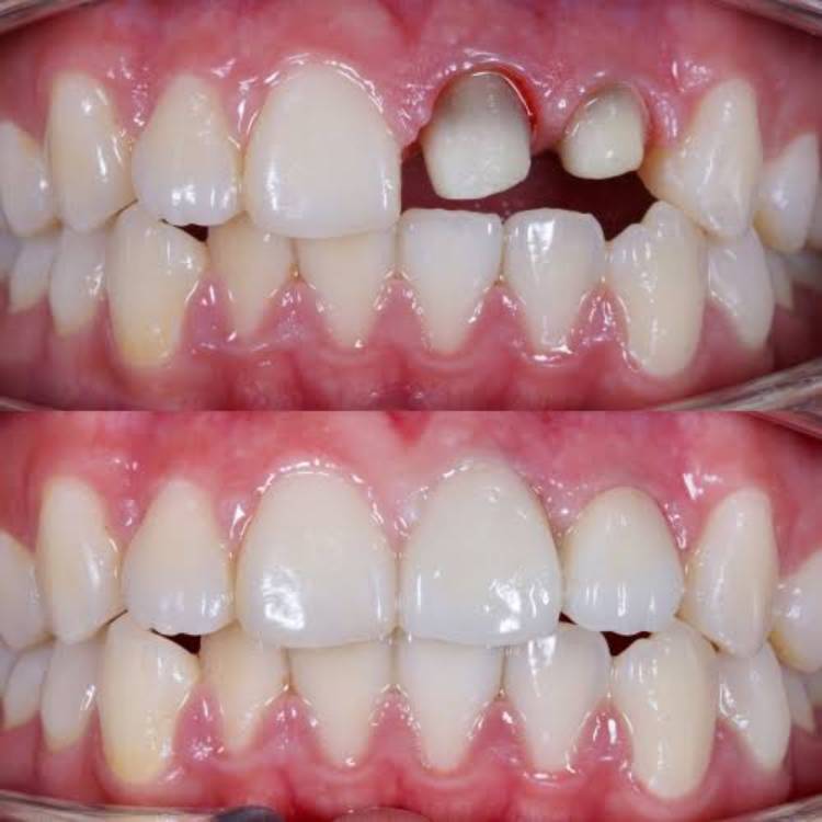 Dental crown cost in Toronto