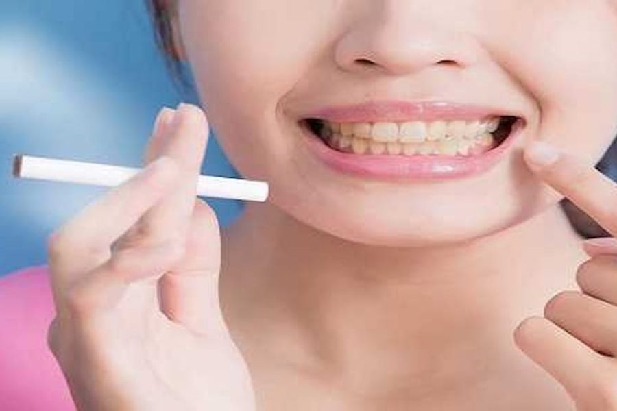 Teeth Whitening for Smokers: What Is the most effective option?