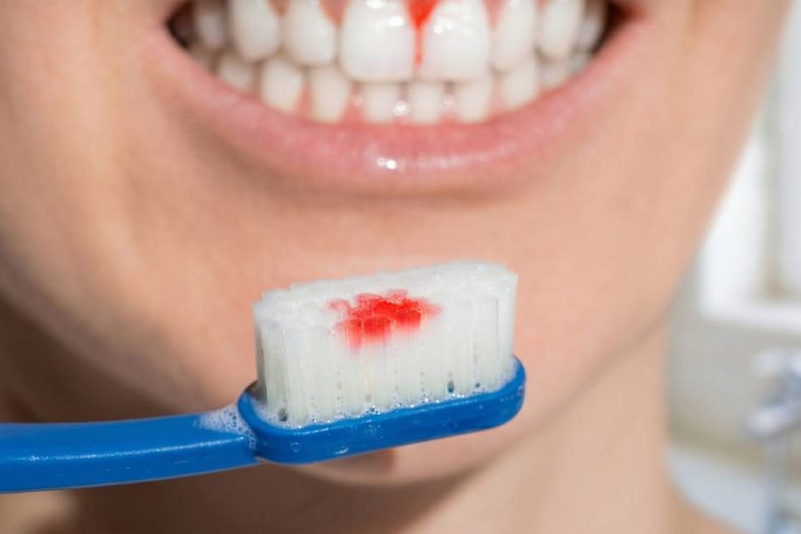 Causes sof bleeding gums; full guide