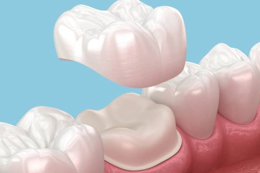 Dental crown cost in Toronto