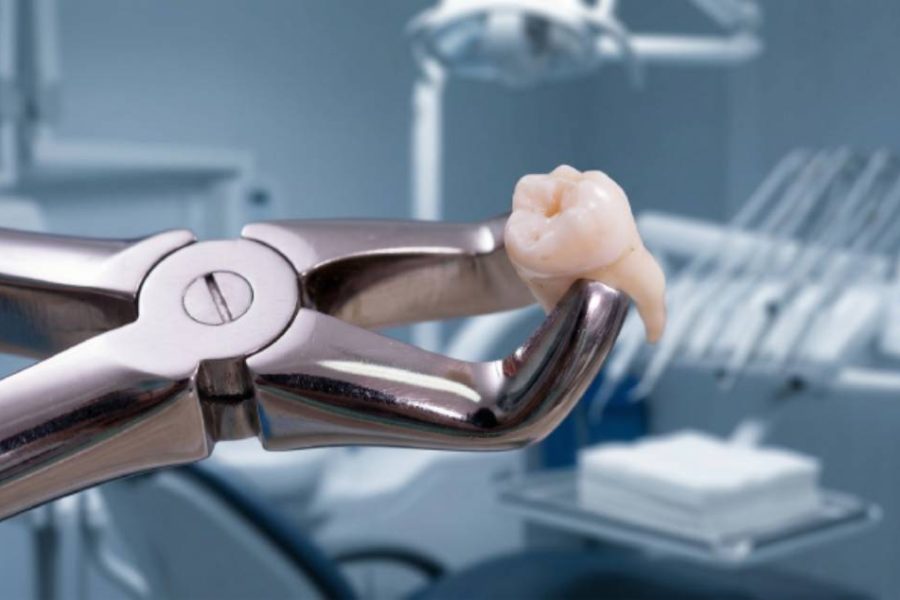 Things to know about tooth extraction healing time