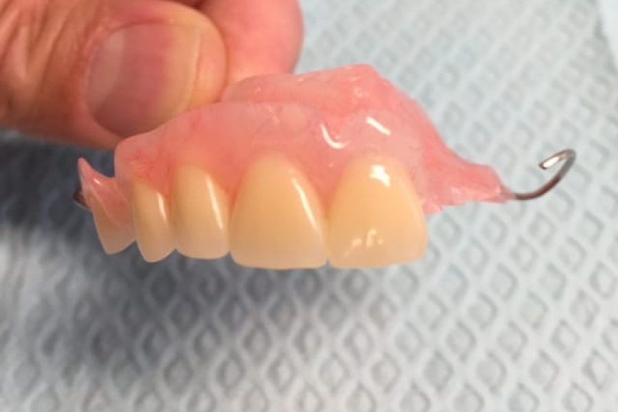 flexible partial dentures for upper teeth