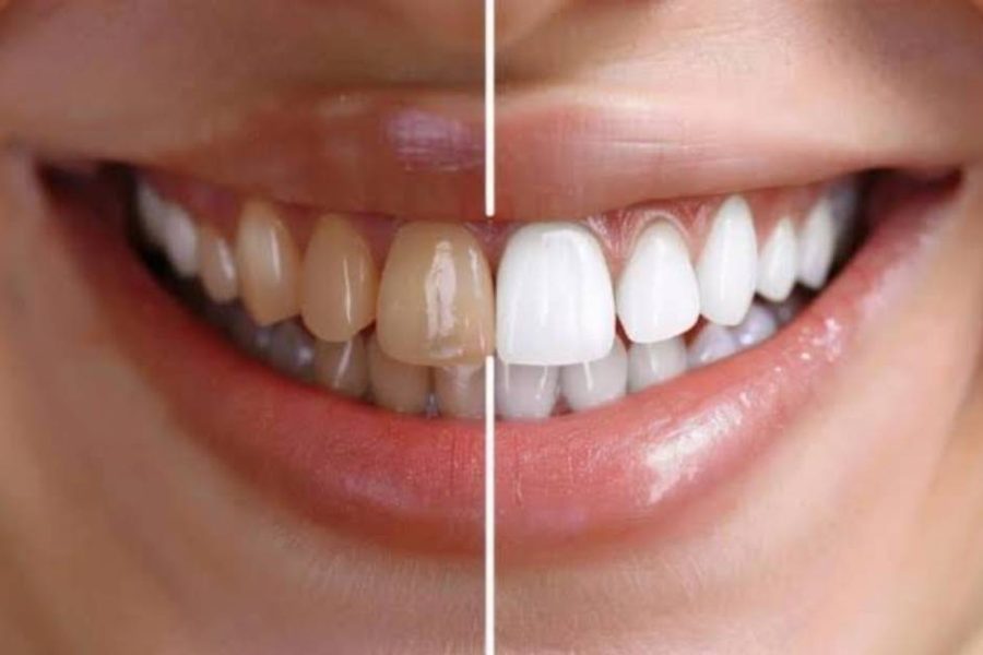 whitening fillings on front teeth