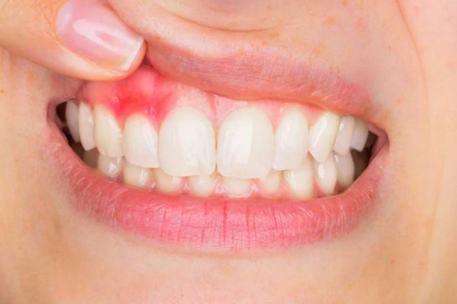 How to treat gum abscess