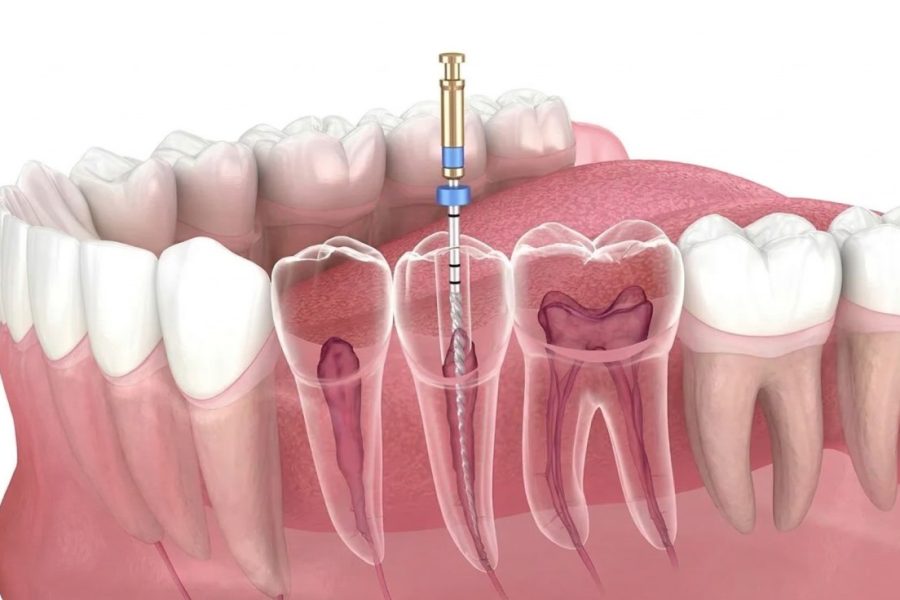 Everything about root canal pain relief