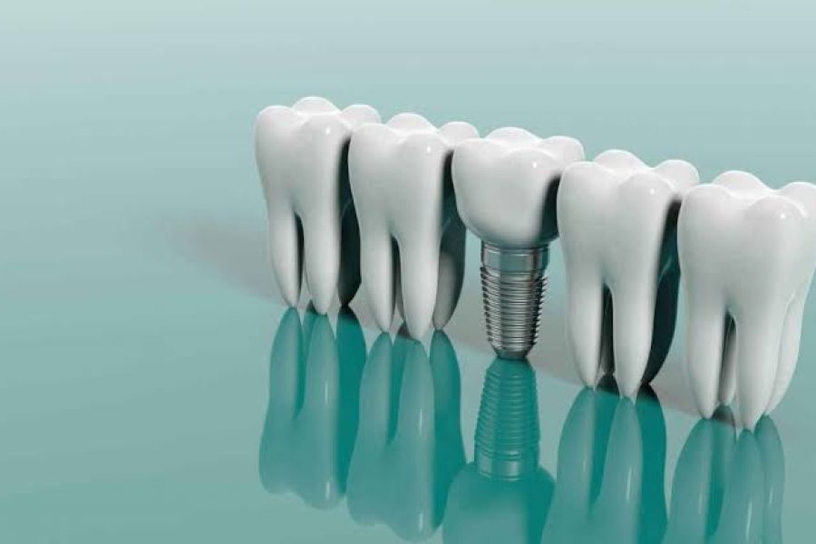screwless dental implants in Toronto